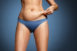 Emagrecer com cirurgia estética e bariátrica