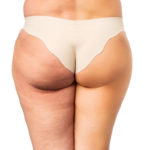 estratégias para reduzir a celulite