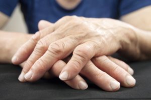 mãos com artrite reumatóide
